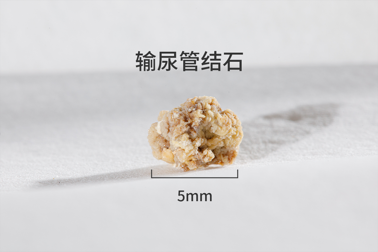 佛山体外碎石，佛山体外碎石医院，佛山体外碎石哪家医院好