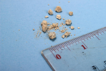 佛山碎石,佛山泌尿碎石,佛山碎石医院