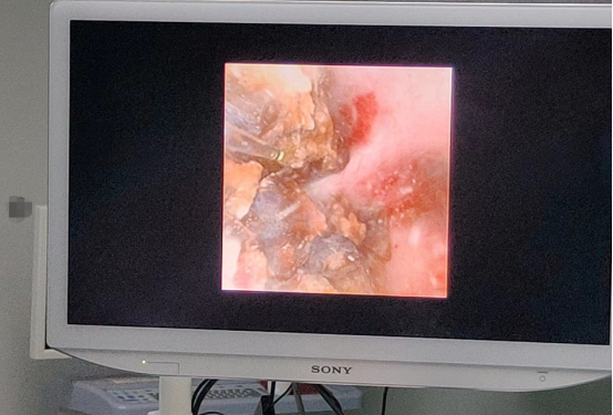 佛山碎石，佛山碎石医院，佛山泌尿碎石