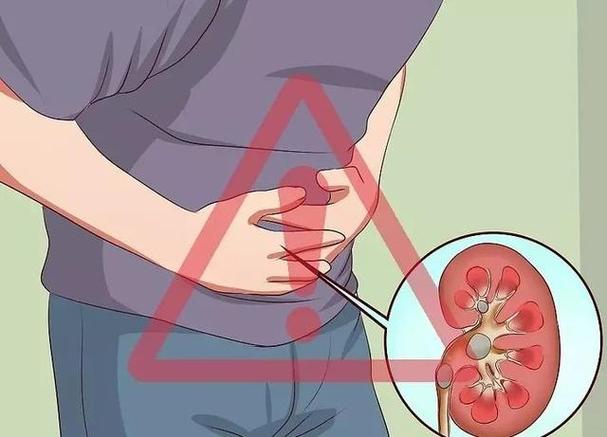 佛山结石，佛山结石医院，佛山泌尿结石