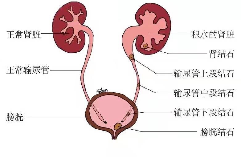 佛山碎石,佛山碎石医院,佛山泌尿碎石
