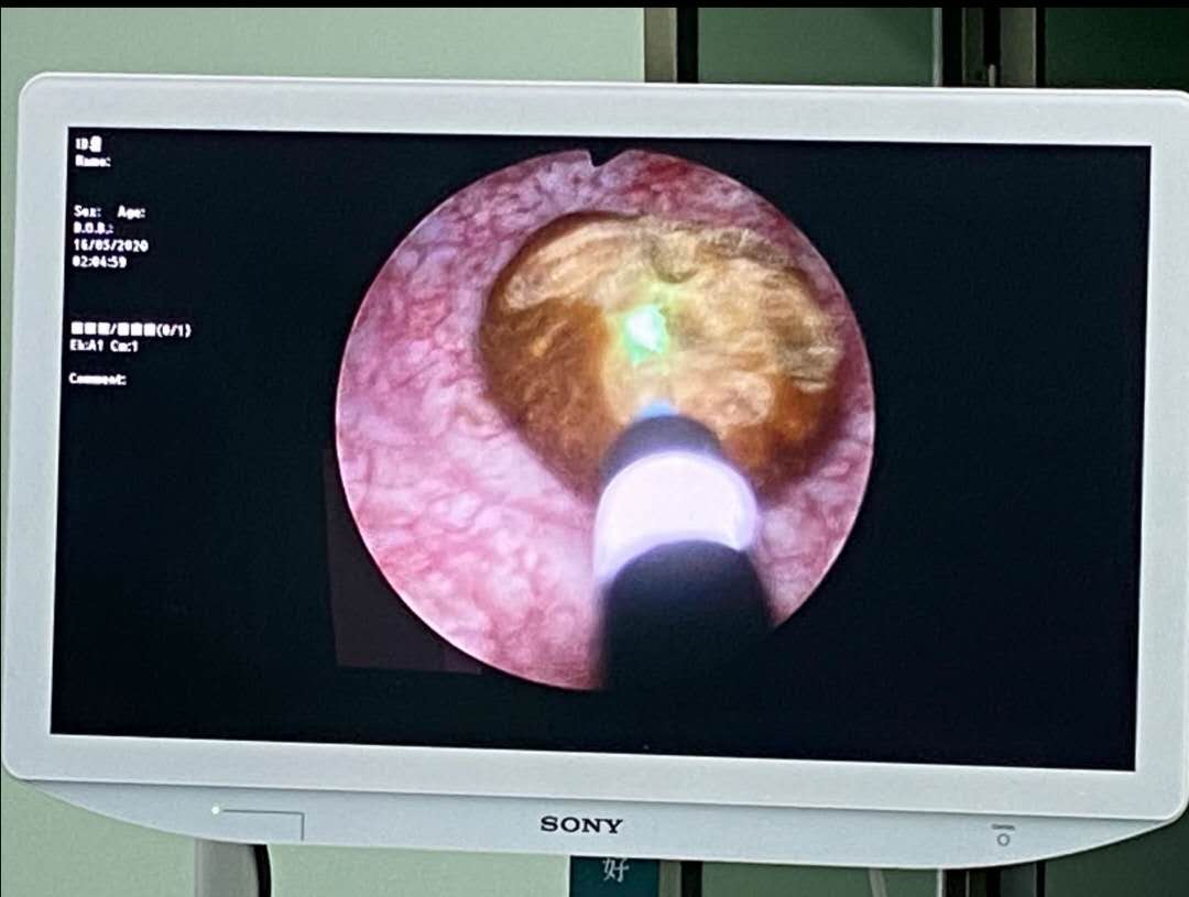 佛山碎石，佛山碎石医院，佛山泌尿碎石