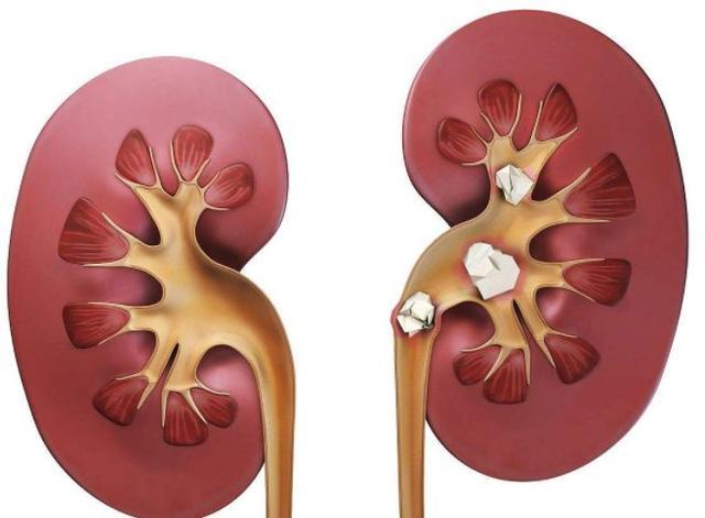 佛山结石,佛山结石医院,佛山泌尿结石