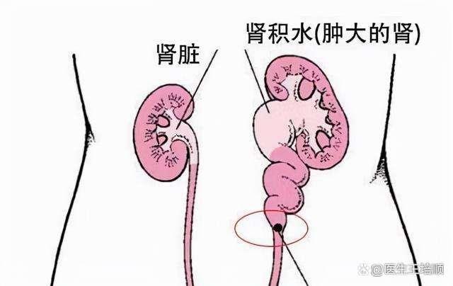 佛山结石,佛山结石医院,佛山泌尿结石