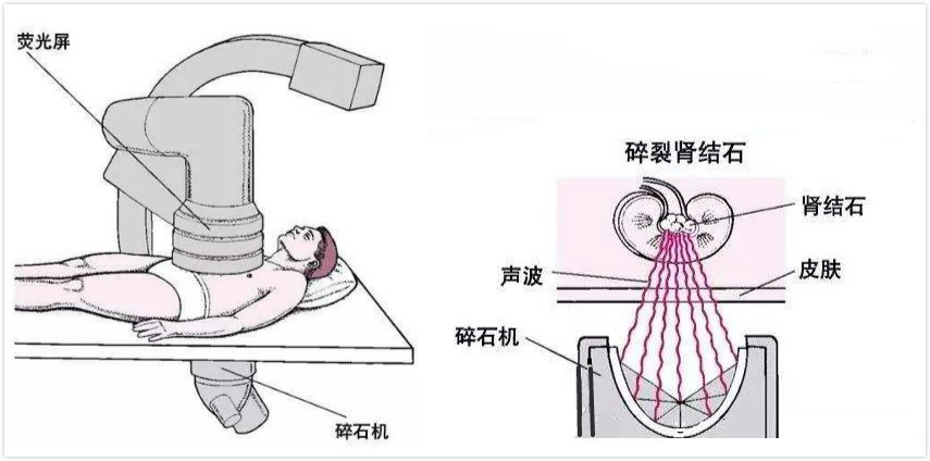 佛山碎石,佛山碎石医院,佛山泌尿碎石