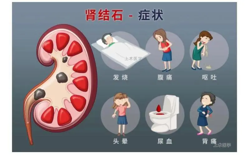 佛山结石,佛山泌尿结石,佛山结石医院