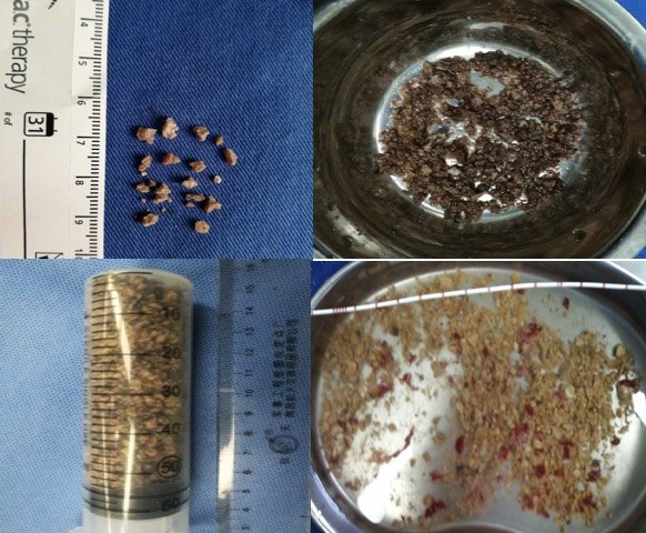 佛山医院结石排名信得过吗?