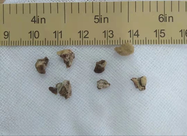 佛山治疗肾结石,佛山治疗肾结石医院,佛山治疗肾结石比较好的医院